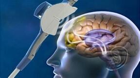 Transcraniële Magnetische Stimulatie (TMS)